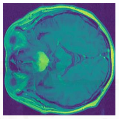 Meningioma